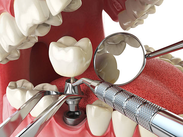 Best Emergency Broken Tooth Repair in Mountain City, GA